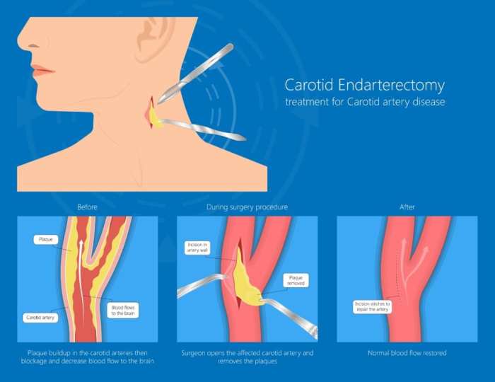 Cpt code for endarterectomy carotid